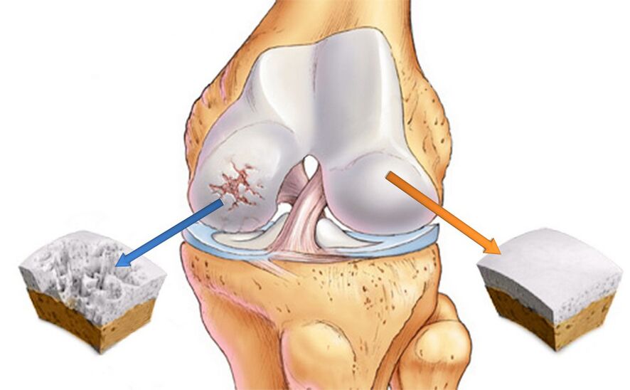 Osteoarthritis of the knee joint