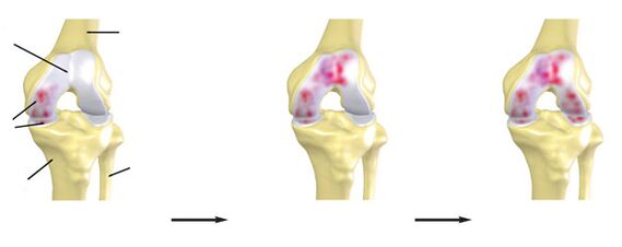 The degree of osteoarthritis of the knee joint