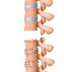 Stages of the neck ramps in the neck