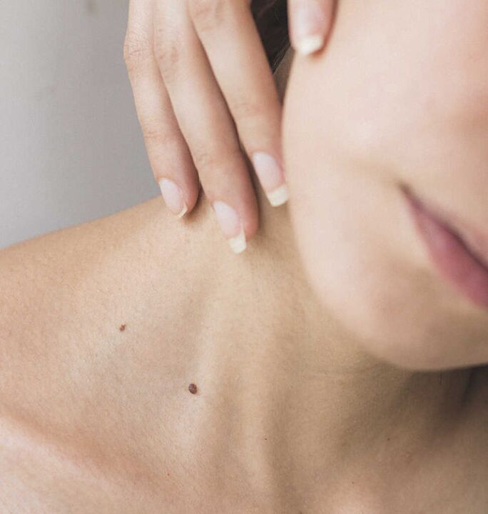 Neck stiffness is one of the symptoms of the initial stage of osteochondrosis of the cervical spine